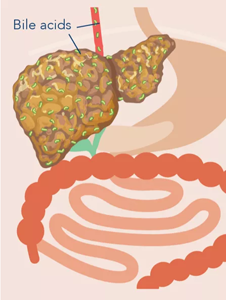 elevated-bile-acids-infographic